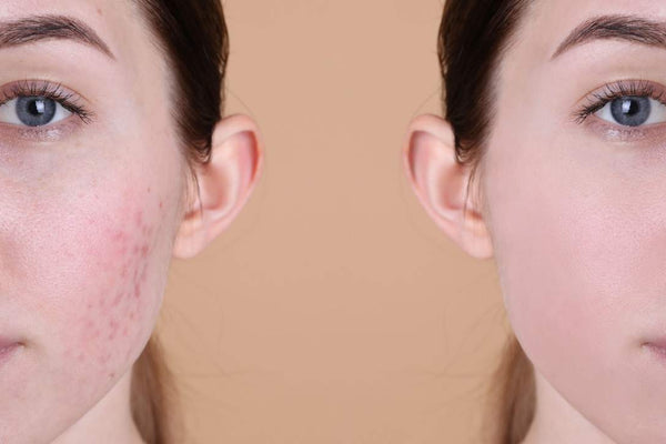 Calcaire et peau sèche : comment l’eau filtrée peut protéger votre visage ?