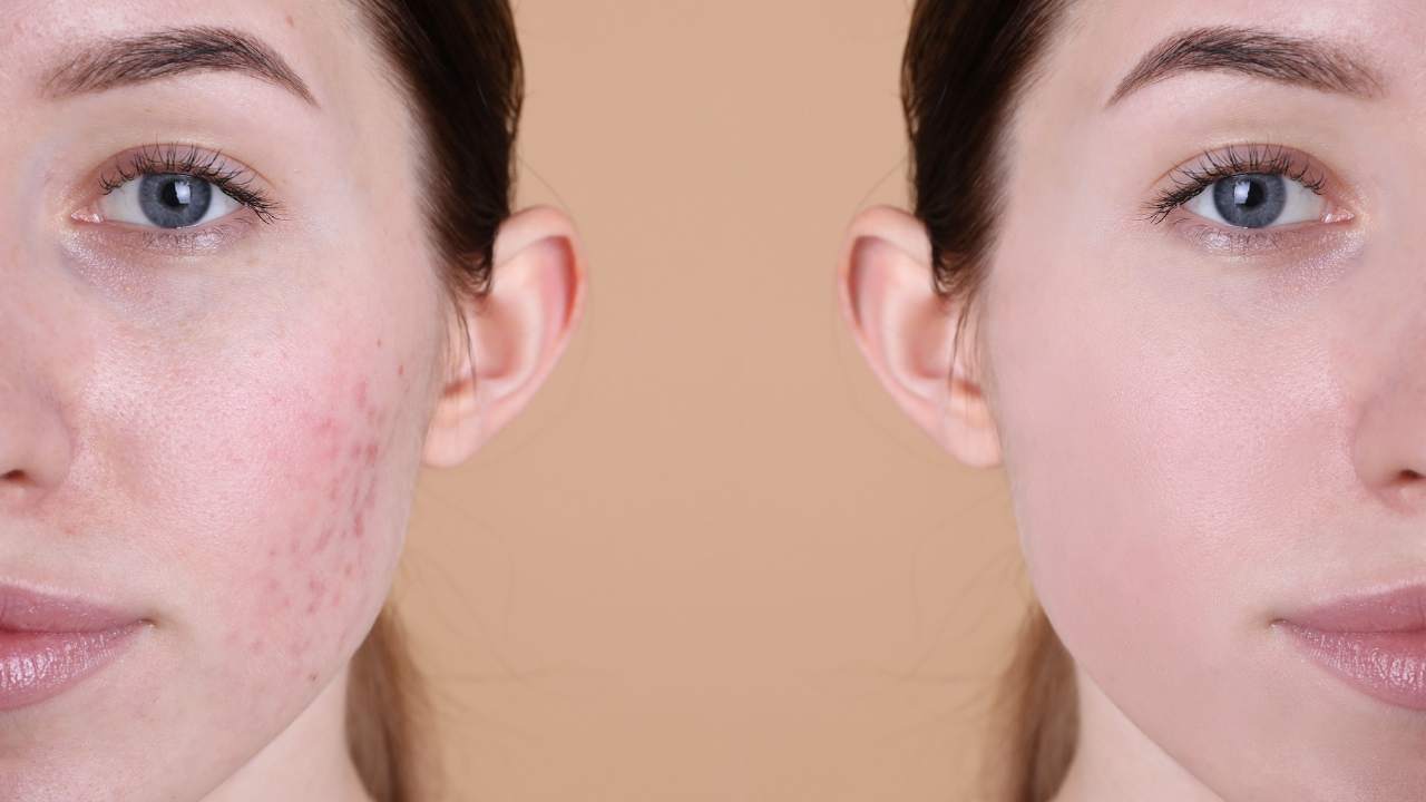 Calcaire et peau sèche : comment l’eau filtrée peut protéger votre visage ?